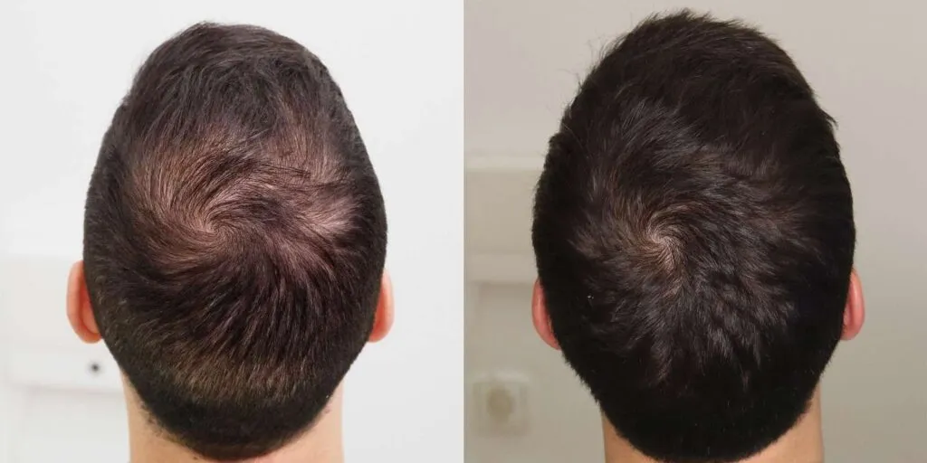 لوسیون تقویت کننده موی آقایان کپیل اکتیو ژاک آندرل-داروخانه آنلاین آدارو