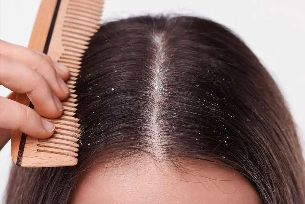 شامپو ضد شوره انواع مو راکوتن- داروخانه آنلاین ادارو